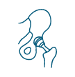 Revision Hip Replacement